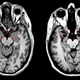 MRI de “X”